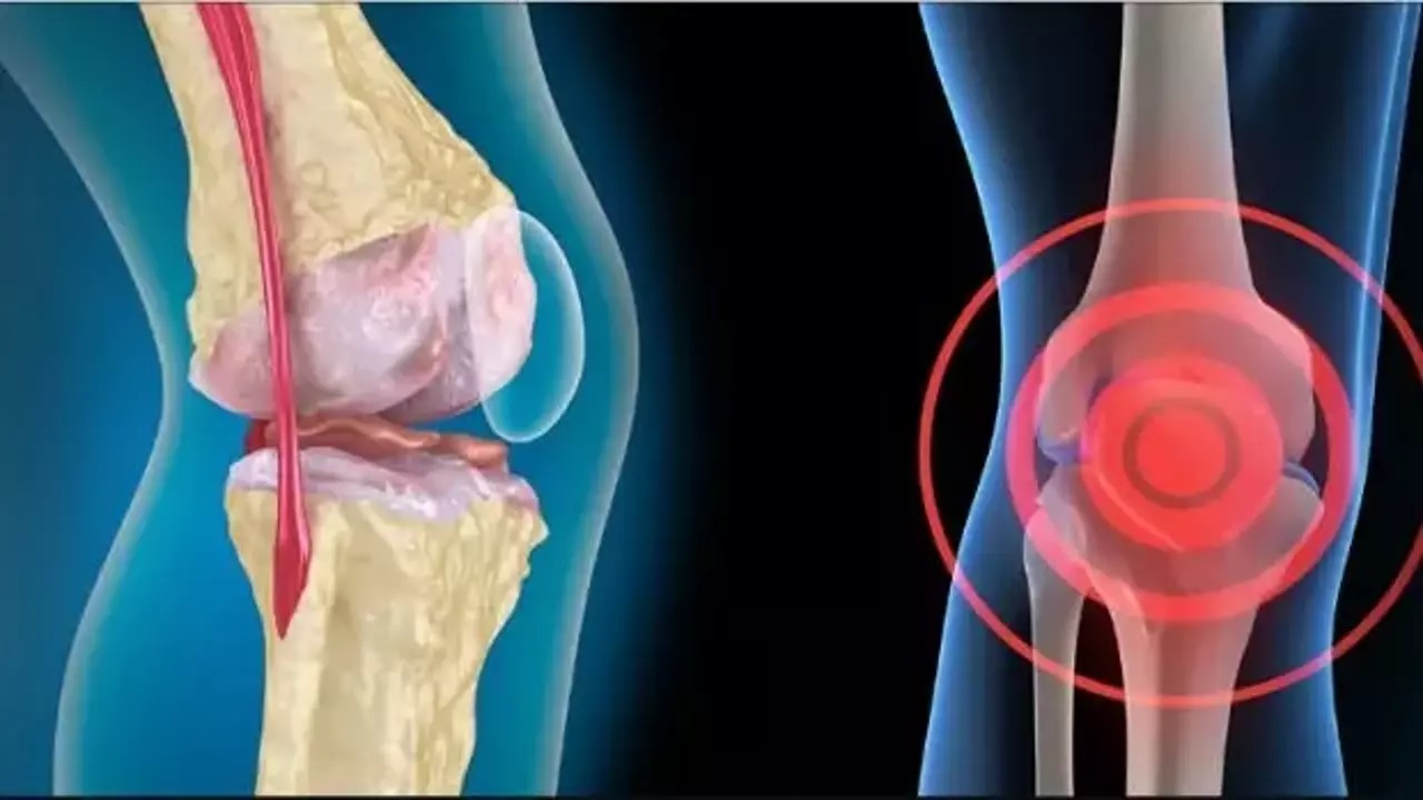 Kireçlenmeye Kök Hücre Tedavisi 2