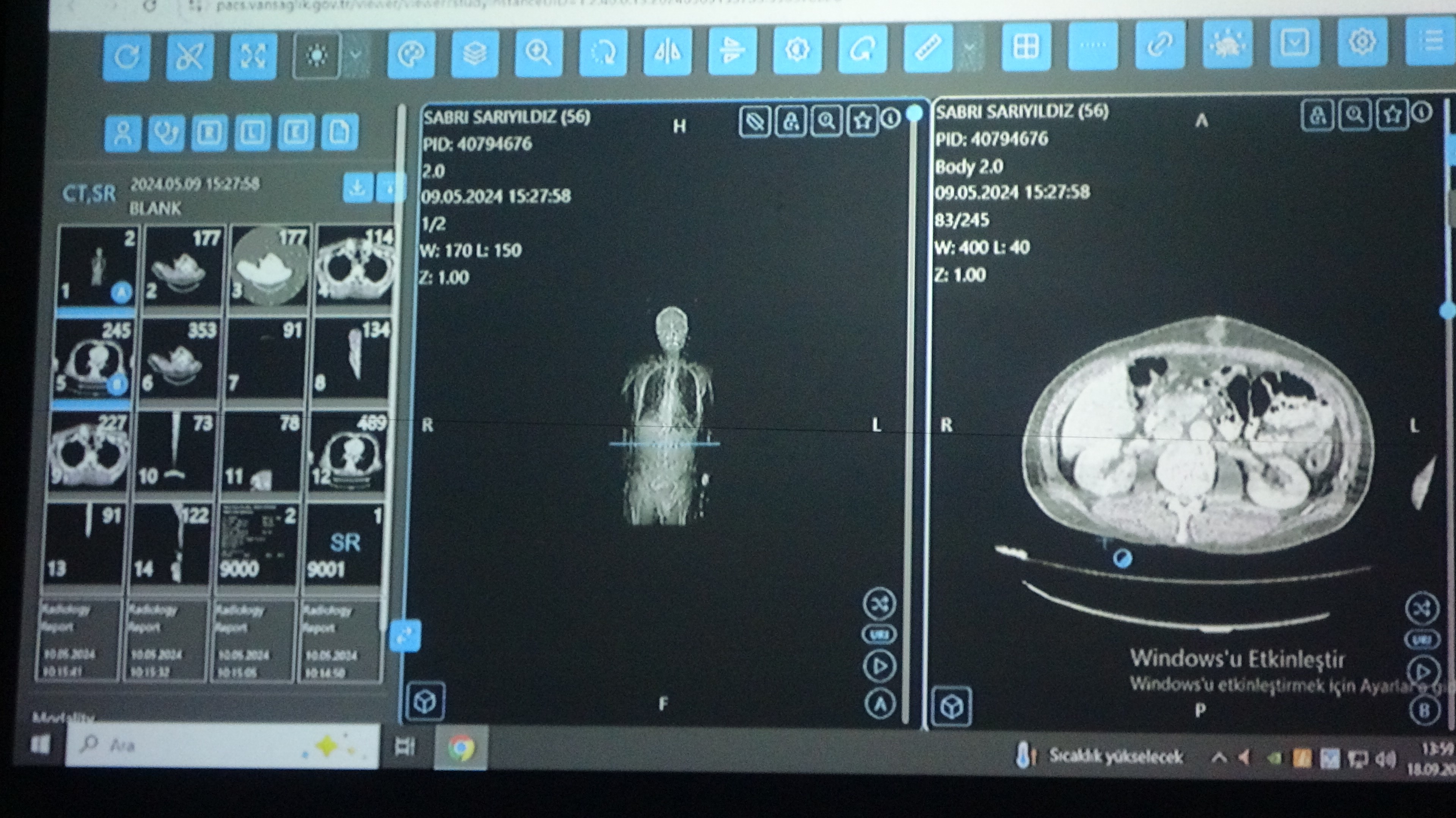 Van’dan Kanser Tedavisinde Yapay Zekâ Desteği (1)