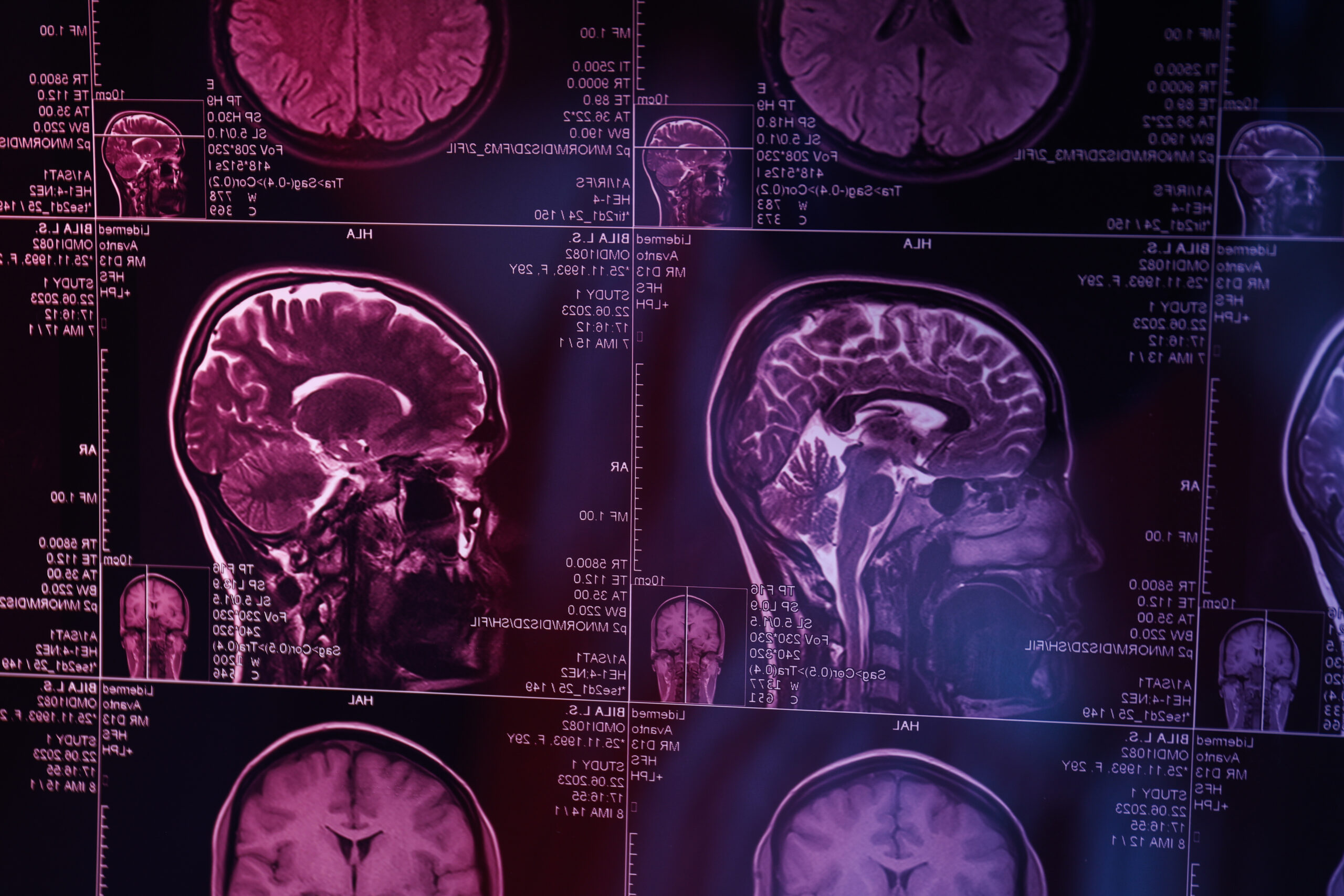 İnme Artık Gençleri Tehdit Ediyor (1)