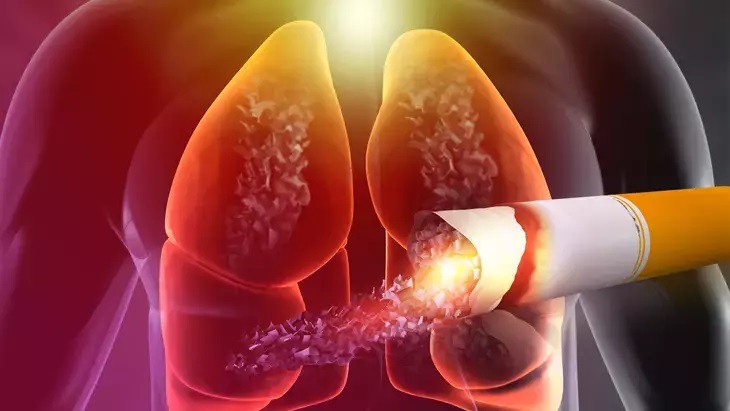 Akciğer Kanseri (2)