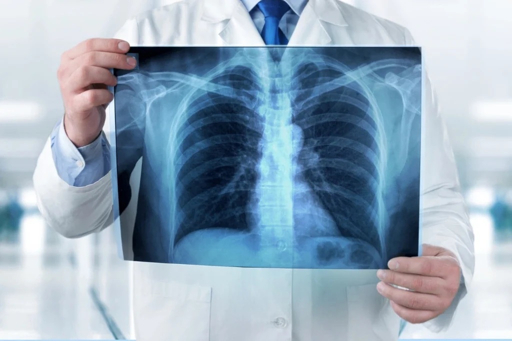 Akciğer Kanseri (3)