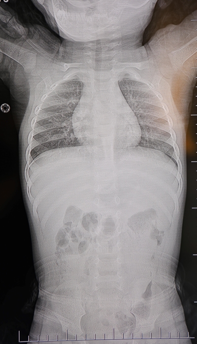 1 Yaşındaki Bebeğin Sırtından Zımba Teli Çıktı (1)