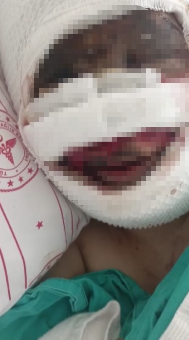 Eski Koca Vahşeti Genç Kadının Başına Asit Döktü!1