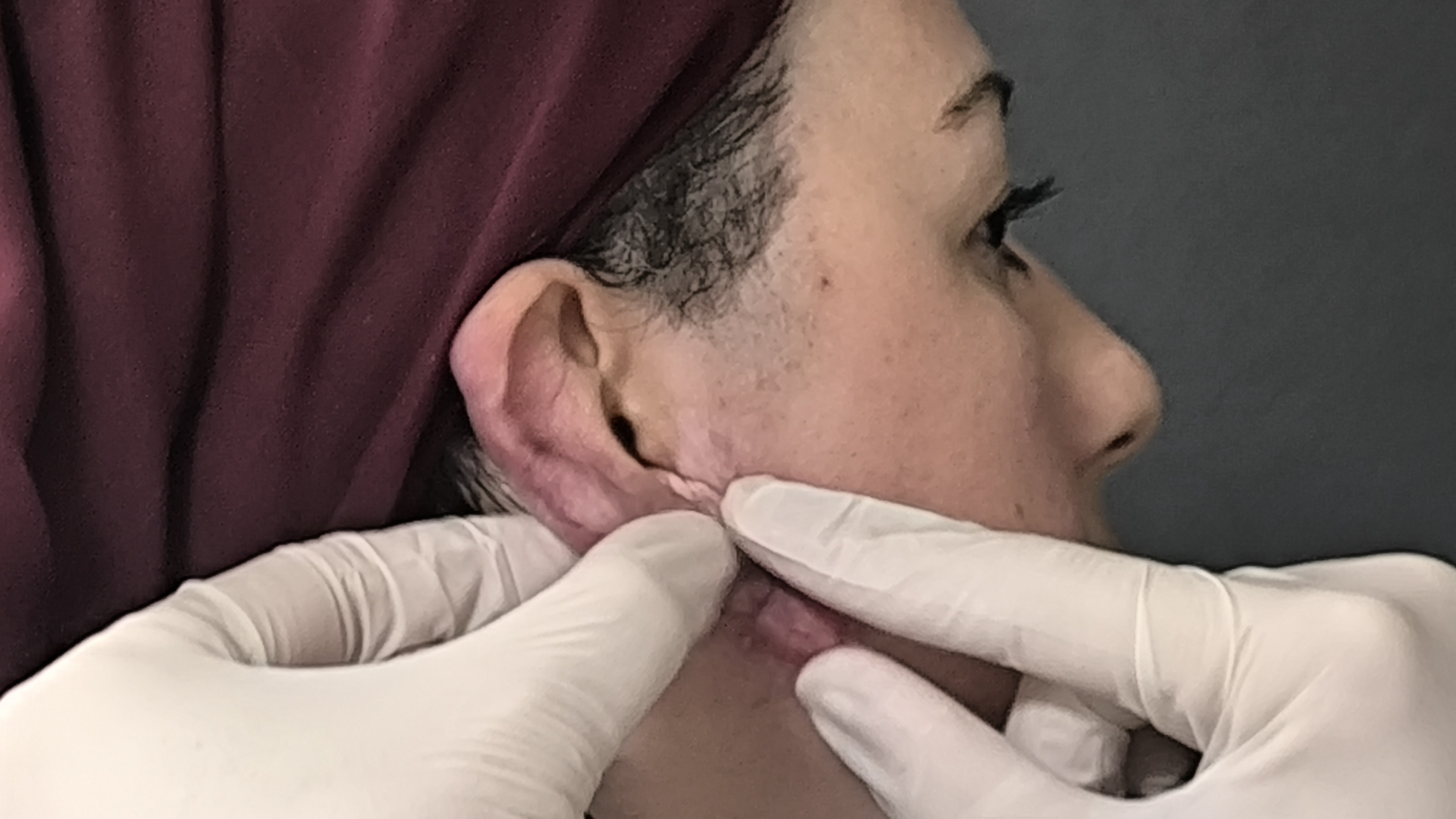 Ödüllü Cerrahi Yöntemle Keloid Tedavisi-1