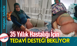 53 Yaşındaki Kadın, 35 Yıllık Fil Hastalığı için Destek Bekliyor!