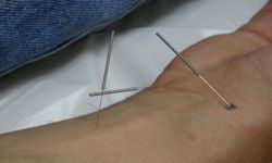 Akupunkturla Şifa: Hastalar Sağlığına Kavuştu!