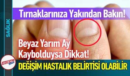 Tırnaklarınızdaki Beyaz Yarım Ay Kaybolduysa Dikkat!