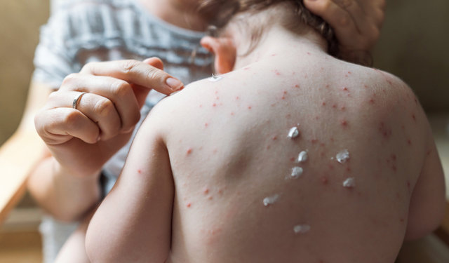 Uzmandan Suçiçeği Uyarısı: Vakalarda Ciddi Artış Var!