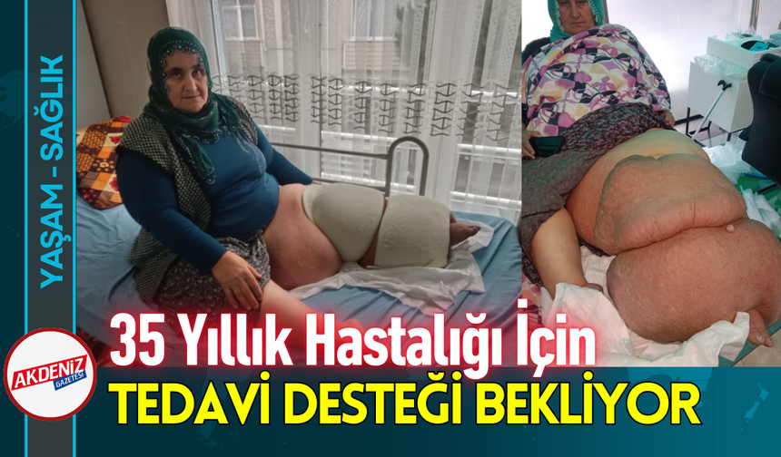53 Yaşındaki Kadın, 35 Yıllık Fil Hastalığı için Destek Bekliyor!