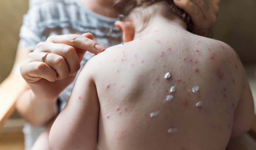 Uzmandan Suçiçeği Uyarısı: Vakalarda Ciddi Artış Var!